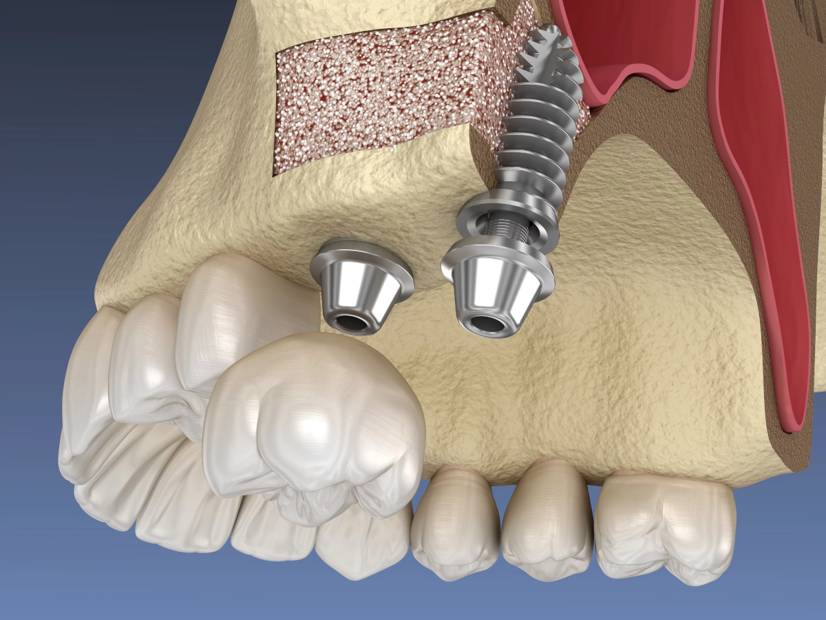 implantate-knochenaufbau-zahnarztpraxis-dr-sperber